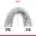 Капа для брекетов OPRO Instant Single Colour Braces Clear-взрослая